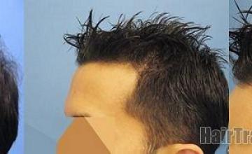 hair transplant results showing left views.