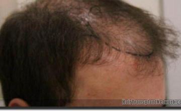 Hair restoration procedure results