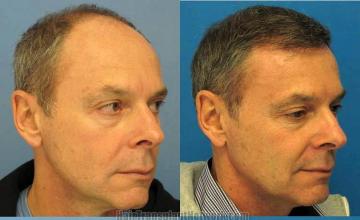 Right view - Before and after hair transplantation