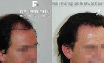 Photos showing before and after hair restoration