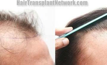 Hair restoration procedure before and after results