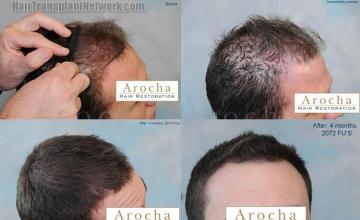 Before and after hair transplantation result photographs