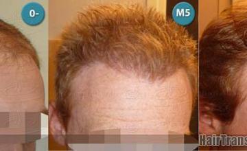 Hair restoration procedure before and after results