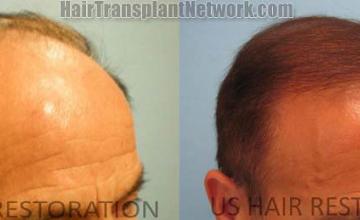 Hair transplantation surgery before and after photos