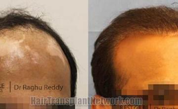 Hair transplantation surgery before and after photos