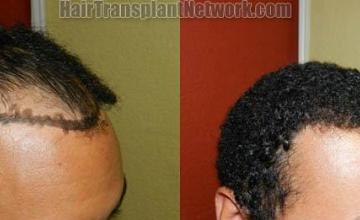 Hair transplantation surgery before and after photos
