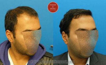 Hair transplantation surgery before and after images