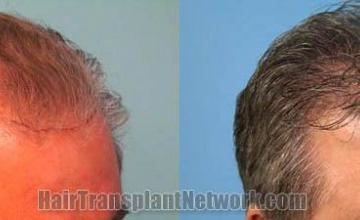 Hair transplantation surgery before and after pictures