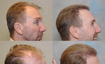 Right side views - showing before and after results from hair transplant