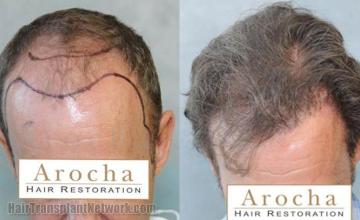 Hair restoration procedure before and after results