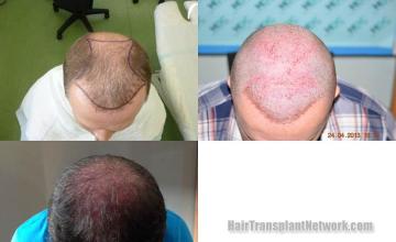 Hair transplantation surgery before and after images