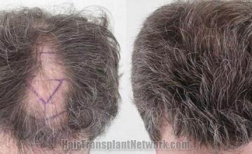 Top view before and after hair restoration results