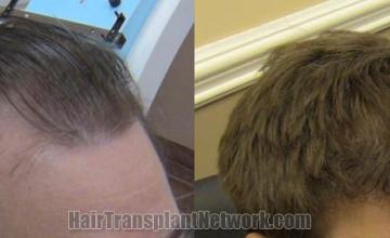 Hair transplantation surgery before and after images