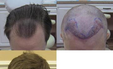 Hair transplantation surgery before and after photos