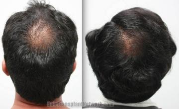 Hair restoration procedure before and after pictures