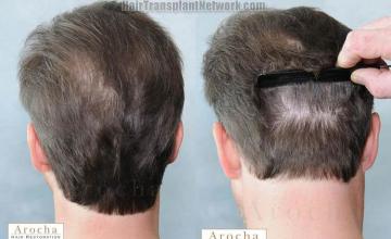 Hair transplantation surgery before and after pictures