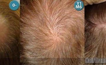 Hair replacement procedure before and after pictures