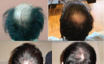 Hair restoration procedure before and after pictures