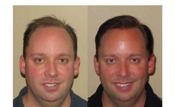Hair transplant results - Front view - Two sessions