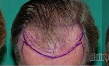 Hair transplant results showing frontal view