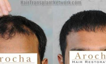 Hair restoration procedure before and after results