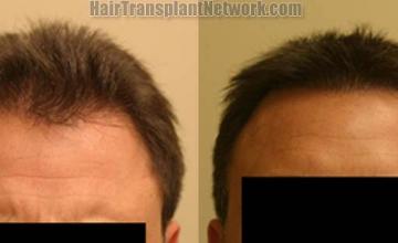 Hair restoration procedure before and after results