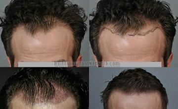 Hair restoration procedure before and after results