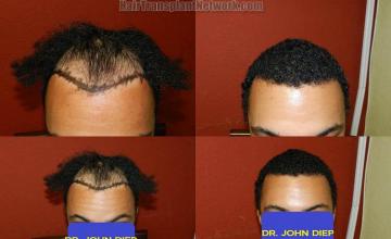 Before and after hair transplantation result photographs