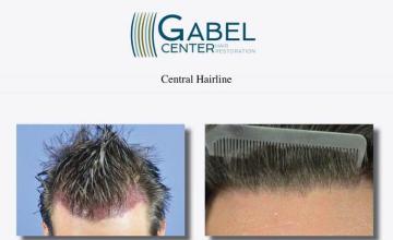 Hair restoration procedure before and after results