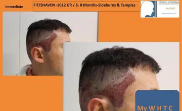 Hair restoration surgery immediate postoperative images