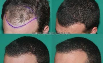 Hair restoration procedure before and after results