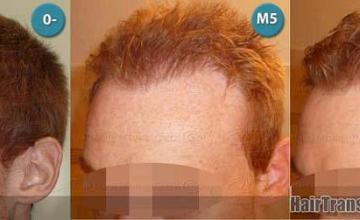 Hair transplantation surgery before and after photos