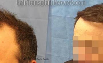 Hair restoration procedure before and after pictures