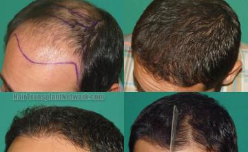 Hair transplantation surgery before and after pictures