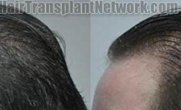 Hair transplantation surgery before and after images