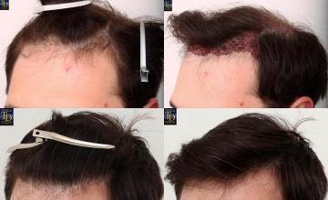 Hair transplantation surgery before and after images