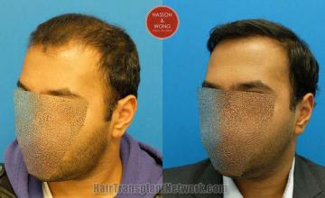 Hair transplantation surgery before and after pictures