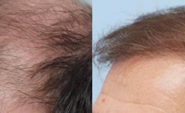 Hair transplantation surgery before and after pictures