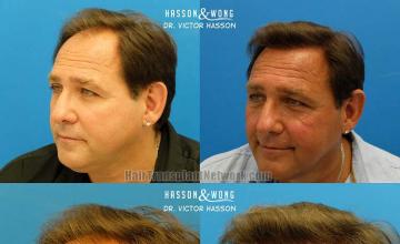 Hair transplantation surgery before and after pictures