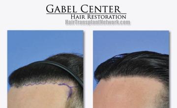 Hair transplant surgery before and after pictures