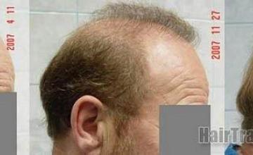 Right view of hair replacement surgery photos