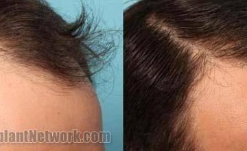 Before and after hair transplant procedure images