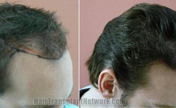 Before and after hair transplantation result photographs