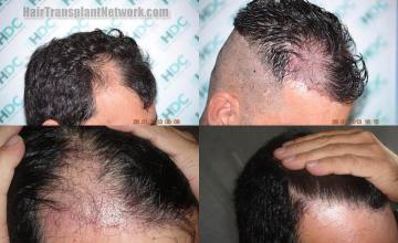 Hair transplantation surgery before and after images