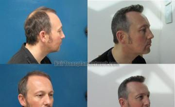 Hair transplantation surgery before and after images