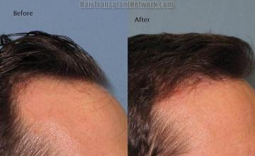 Hair transplantation surgery before and after images