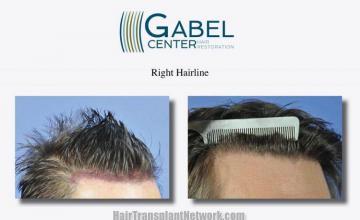 Hair transplantation surgery before and after pictures