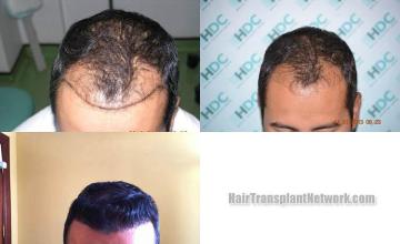 Hair restoration surgery before and after images