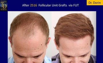 Hair restoration procedure before and after results