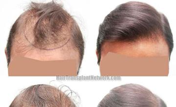 Before and after hair transplant procedure images